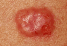 Skin Cancer: How You Can Save Your Life