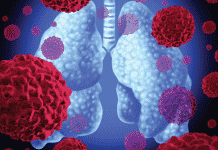 Easier Detection of Lung Cancer Tumors on the Horizon