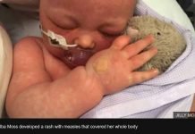 Proof: Watch a Real Baby Suffer from Real Measles